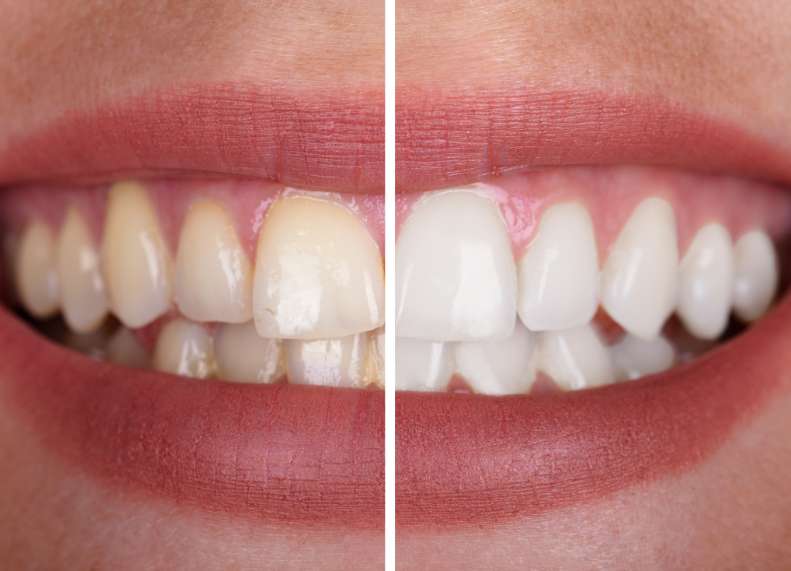 Teeth Whitening in Dubai with MYO Medical Center