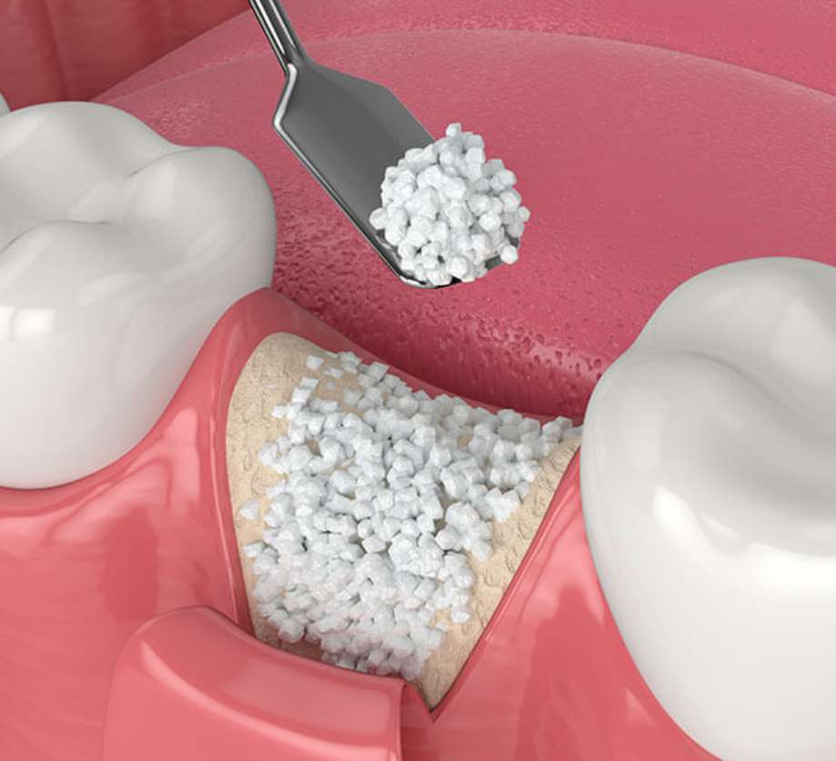 Bone Grafting