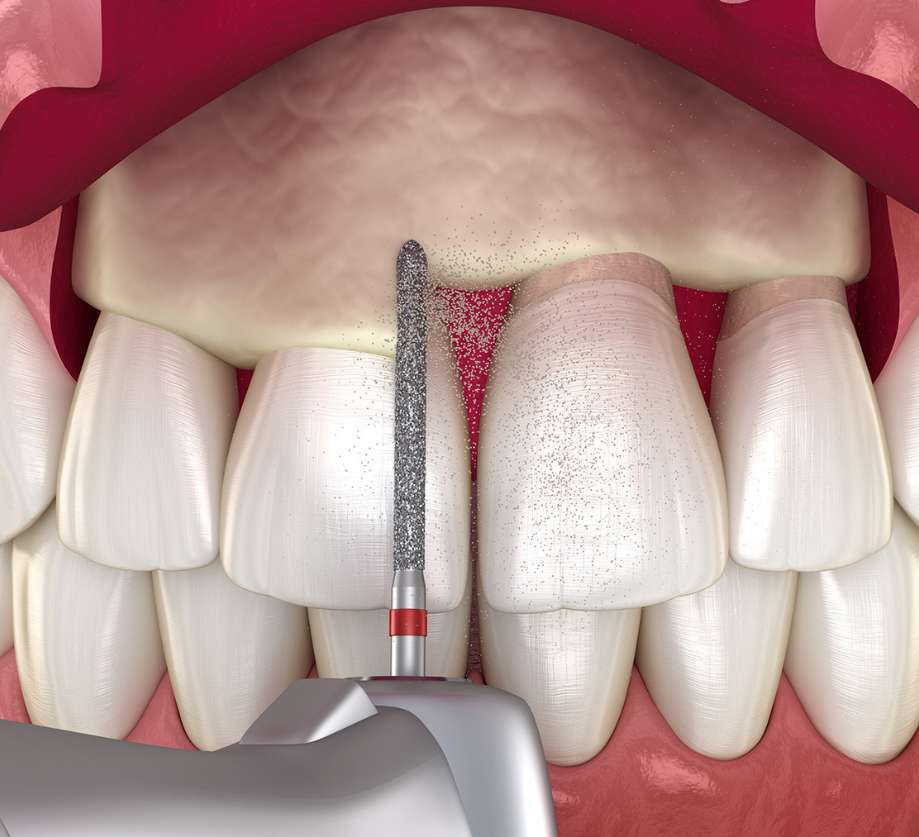 Crown Lengthening