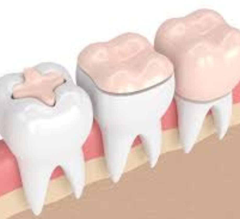 Dental Restorations