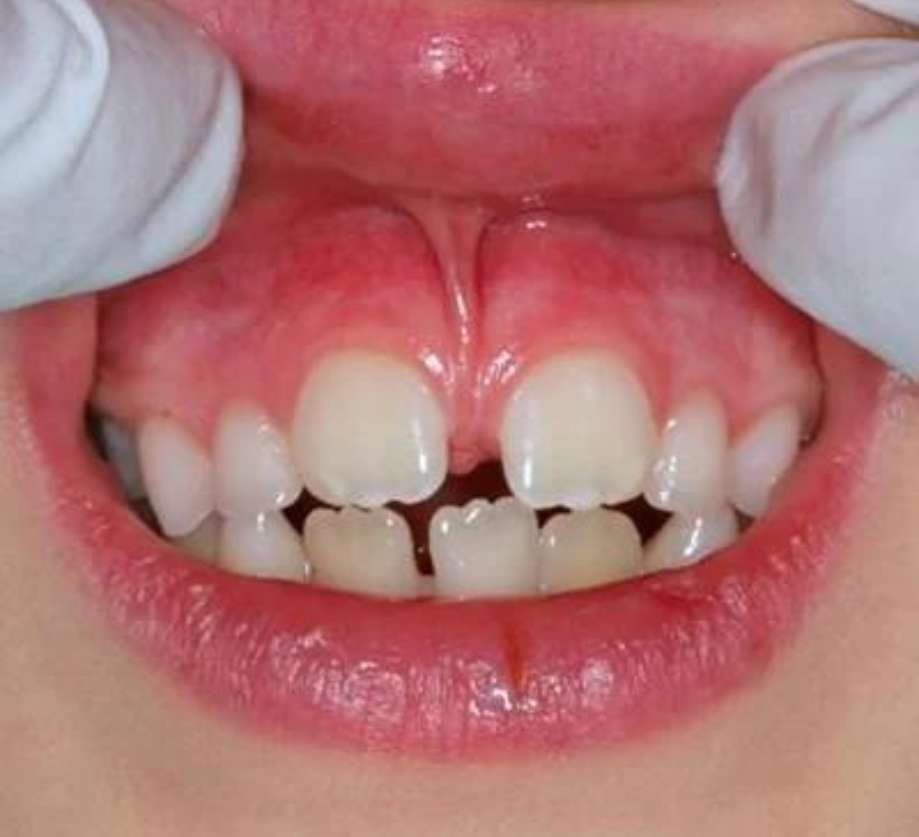 Frenectomy