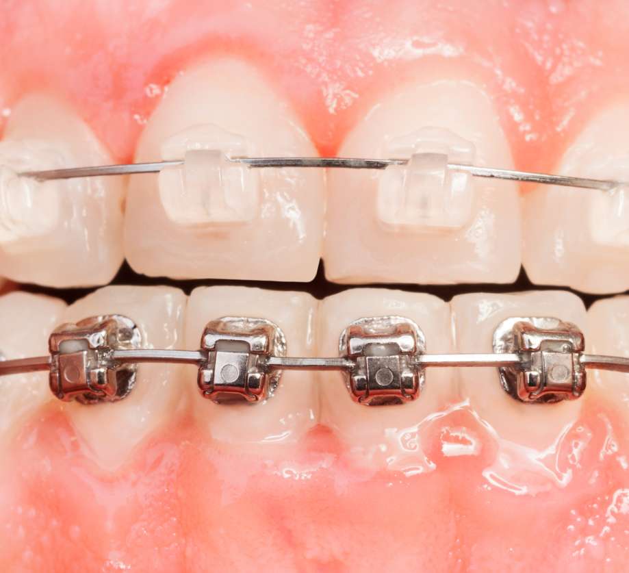 Metal And Ceramic Braces