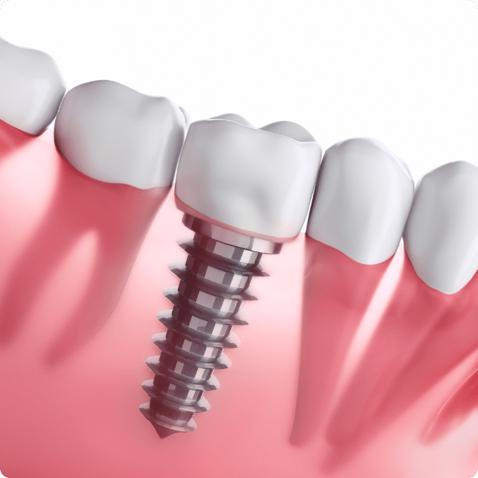 Dental Implants