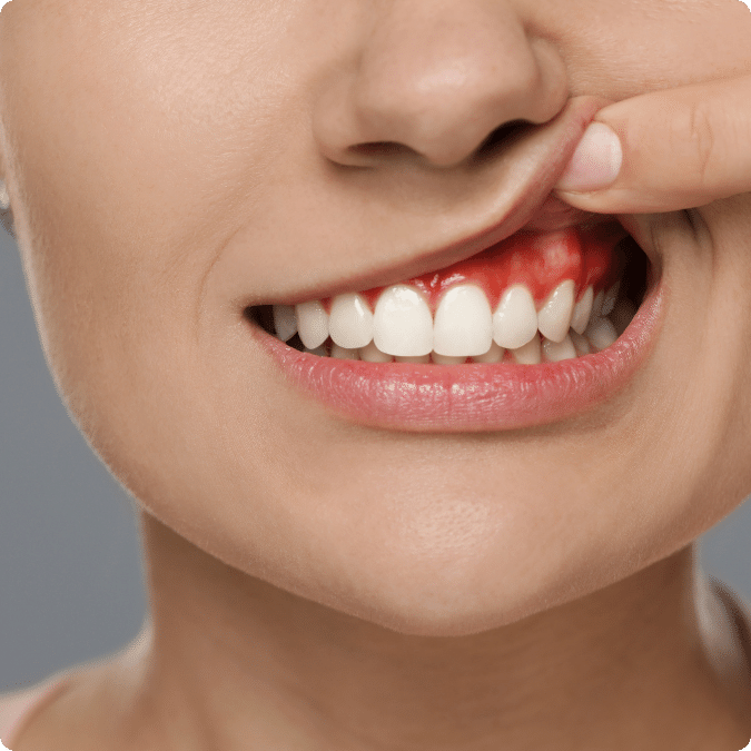 Gum Disease Treatment