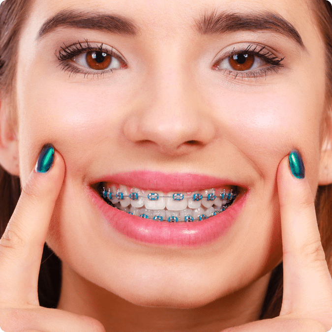 Orthodontic Braces