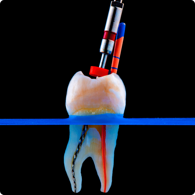 Root Canal Treatment