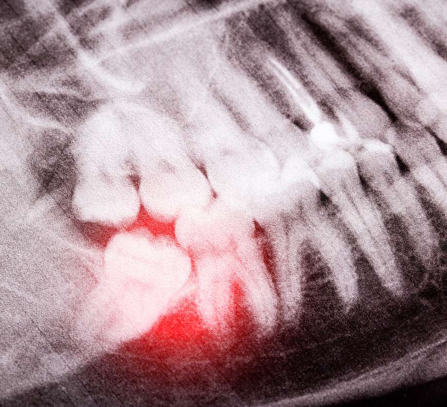 Wisdom Tooth Extraction