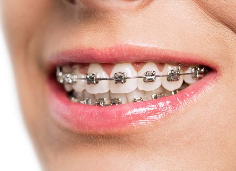 Damon braces can be at MYO Medical Centre to get your perfect smile